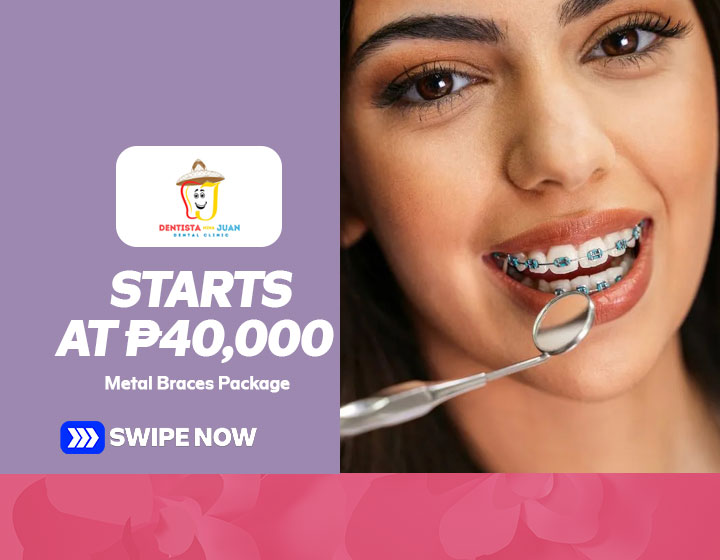 Metal Braces Package starts at P40,000
