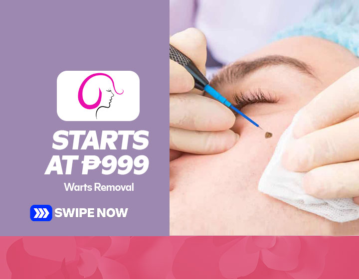 Warts Removal starts at P999