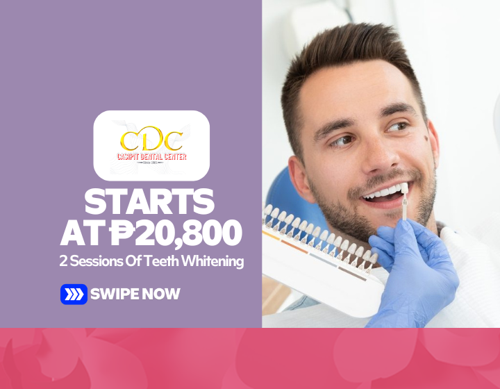 2 Sessions Of Teeth Whitening Starting At P20,800