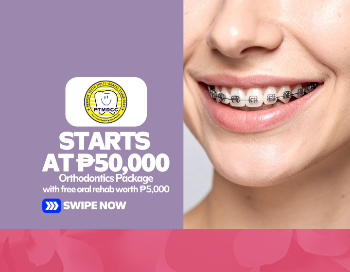 Orthodontics Package Starting At P50,000