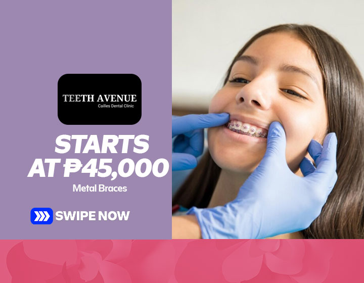 Metal Braces start at P45,000